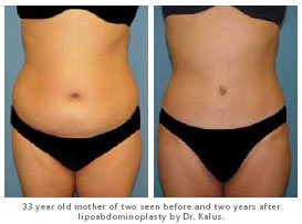 Plastic Surgery of the Carolinas: before and after photo of 33 y.o. mother after lipoabdominoplasty performed by Dr Ram Kalus