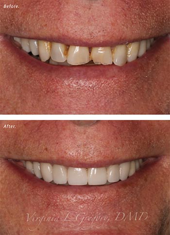 Before and after porcelain veneers.
