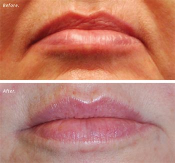 Filler for correction of frown lines and a slight upper-lip augmentation.